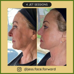 Jet Plasma Pen Treatment Before & After