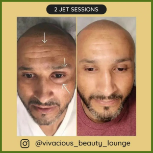 Non-Invasive Skin Tightening with JetPlasma Pen Treatment