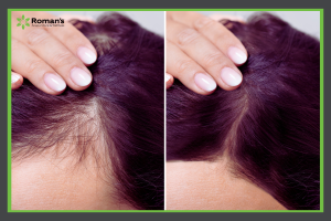 hair restoration treatments at Roman's Wellness Center in Morgantown, WV