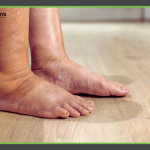 Lipedema vs. Lymphedema - what's the difference and why it matters - Roman's Wellness Center Blog