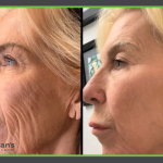 aesthetic treatments Morgantown, WV Romans Wellness Center Blog Ultra Jet T33