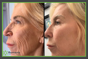 aesthetic treatments Morgantown, WV Romans Wellness Center Blog Ultra Jet T33