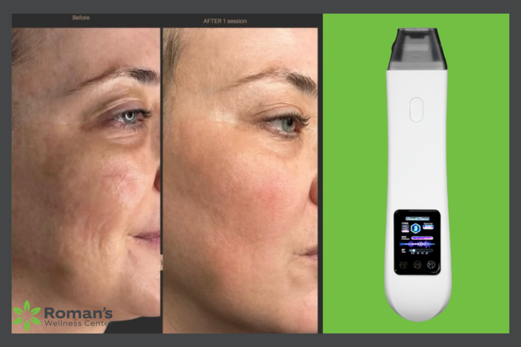 Aesthetic Treatments Morgantown WV Romans Wellness Center Ultra Jet T33